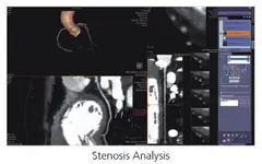  Clinical Images - Stenosis Analysis - ANATOM 128 Revolutionary 128-Slice CT Scanner - KAS Medics Ltd