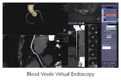  Clinical Images - Blood Vessel Virtual Endoscopy - ANATOM 128 Revolutionary 128-Slice CT Scanner - KAS Medics Ltd