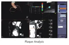  Clinical Images - Plaque Analysis - ANATOM 128 Revolutionary 128-Slice CT Scanner - KAS Medics Ltd
