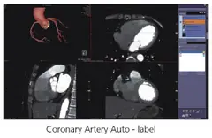  Clinical Images - Coronary Artery - ANATOM 128 Revolutionary 128-Slice CT Scanner - KAS Medics Ltd