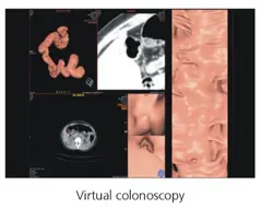  Clinical Images - Virtual Colonoscopy - ANATOM 128 Revolutionary 128-Slice CT Scanner - KAS Medics Ltd