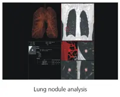  Clinical Images - Lung Nodule Analysis - ASR-4000 Digital Mammography System - KAS Medics Ltd