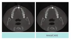  metalCARE - DENTOM CBCT Dental Cone Beam Computed Tomography System - KAS Medics Ltd
