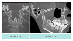  boneCARE - DENTOM CBCT Dental Cone Beam Computed Tomography System - KAS Medics Ltd