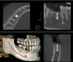  Tooth implantation - DENTOM CBCT Dental Cone Beam Computed Tomography System - KAS Medics Ltd