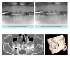  DX FPD Without Linear Artifacts and Non-DXFPD  with linear artifacts - DENTOM CBCT Dental Cone Beam Computed Tomography System - KAS Medics Ltd