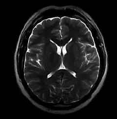 
Clinical Images - Brain T2Wl - OPENMARK 5000 MRI System - KAS Medics Ltd