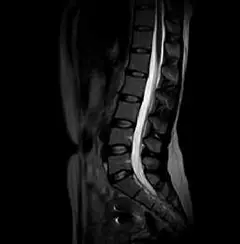 
Clinical Images - L-spine T2Wl - OPENMARK 5000 MRI System - KAS Medics Ltd