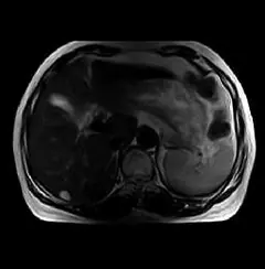 
Clinical Images - Abdomen T2Wl - OPENMARK 5000 MRI System - KAS Medics Ltd