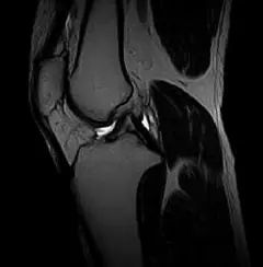 
Clinical Images - Knee T2Wl - OPENMARK 5000 MRI System - KAS Medics Ltd