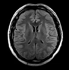 
Clinical Images - Brain FLAIR - OPENMARK 5000 MRI System - KAS Medics Ltd
