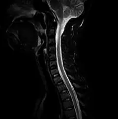 
Clinical Images - C-spine STIR - OPENMARK 5000 MRI System - KAS Medics Ltd