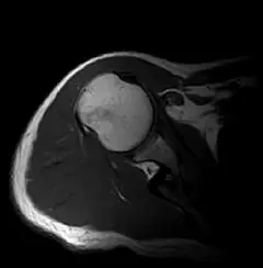 
Clinical Images - Shoulder TlWI - OPENMARK 5000 MRI System - KAS Medics Ltd