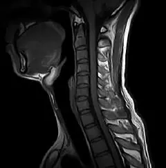 
Clinical Images - C-spine TIWI - OPENMARK 5000 MRI System - KAS Medics Ltd