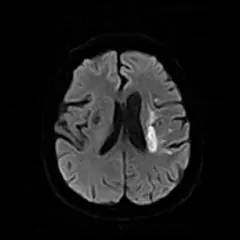 
Clinical Images - Brain - HD-DWI - SuperMark 1.5T Superconducting MRI System - KAS Medics Ltd