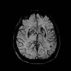 
Clinical Images - Brain - A-SWI - SuperMark 1.5T Superconducting MRI System - KAS Medics Ltd