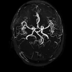 
Clinical Images - Brain - 3D-TOF MRA - SuperMark 1.5T Superconducting MRI System - KAS Medics Ltd