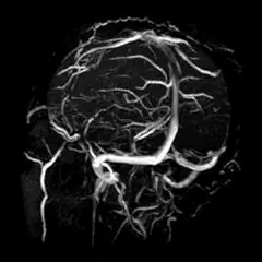 
Clinical Images - Brain - 3D-TOF MRV - SuperMark 1.5T Superconducting MRI System - KAS Medics Ltd