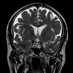 
Clinical Images - Brain - Pitutary Imaging - SuperMark 1.5T Superconducting MRI System - KAS Medics Ltd