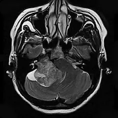
Clinical Images - Brain - Optic Neroma Imaging - SuperMark 1.5T Superconducting MRI System - KAS Medics Ltd
