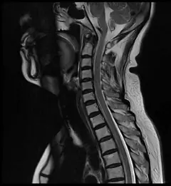 
Clinical Images - C-spine - T2WI - SuperMark 1.5T Superconducting MRI System - KAS Medics Ltd