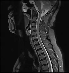 
Clinical Images - C-spine - STIR - SuperMark 1.5T Superconducting MRI System - KAS Medics Ltd