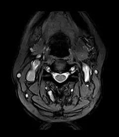 
Clinical Images - C-spine - ME-T2*WI - SuperMark 1.5T Superconducting MRI System - KAS Medics Ltd