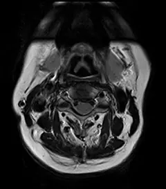 
Clinical Images - C-spine - Tra-T2WI - SuperMark 1.5T Superconducting MRI System - KAS Medics Ltd