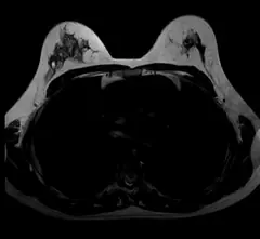 
Clinical Images - Breast - T2WI - SuperMark 1.5T Superconducting MRI System - KAS Medics Ltd