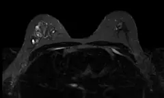 
Clinical Images - Breast - STIR - SuperMark 1.5T Superconducting MRI System - KAS Medics Ltd