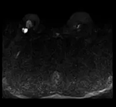 
Clinical Images - Breast - DWI - SuperMark 1.5T Superconducting MRI System - KAS Medics Ltd