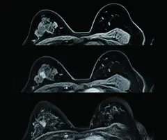 
Clinical Images - Breast - Dynamic Enhancement and Substraction - SuperMark 1.5T Superconducting MRI System - KAS Medics Ltd