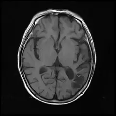 
Clinical Images - Brain - T1WI - SuperMark 1.5T Superconducting MRI System - KAS Medics Ltd