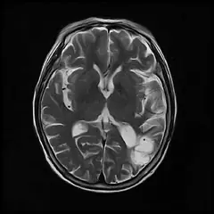 
Clinical Images - Brain - T2WI - SuperMark 1.5T Superconducting MRI System - KAS Medics Ltd