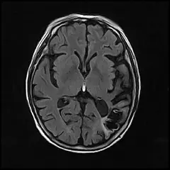 
Clinical Images - Brain - FLAIR - SuperMark 1.5T Superconducting MRI System - KAS Medics Ltd